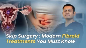 Uterine Fibroid Treatment Without Surgery